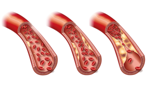 Abbildung von Cholesterin in Arterien.